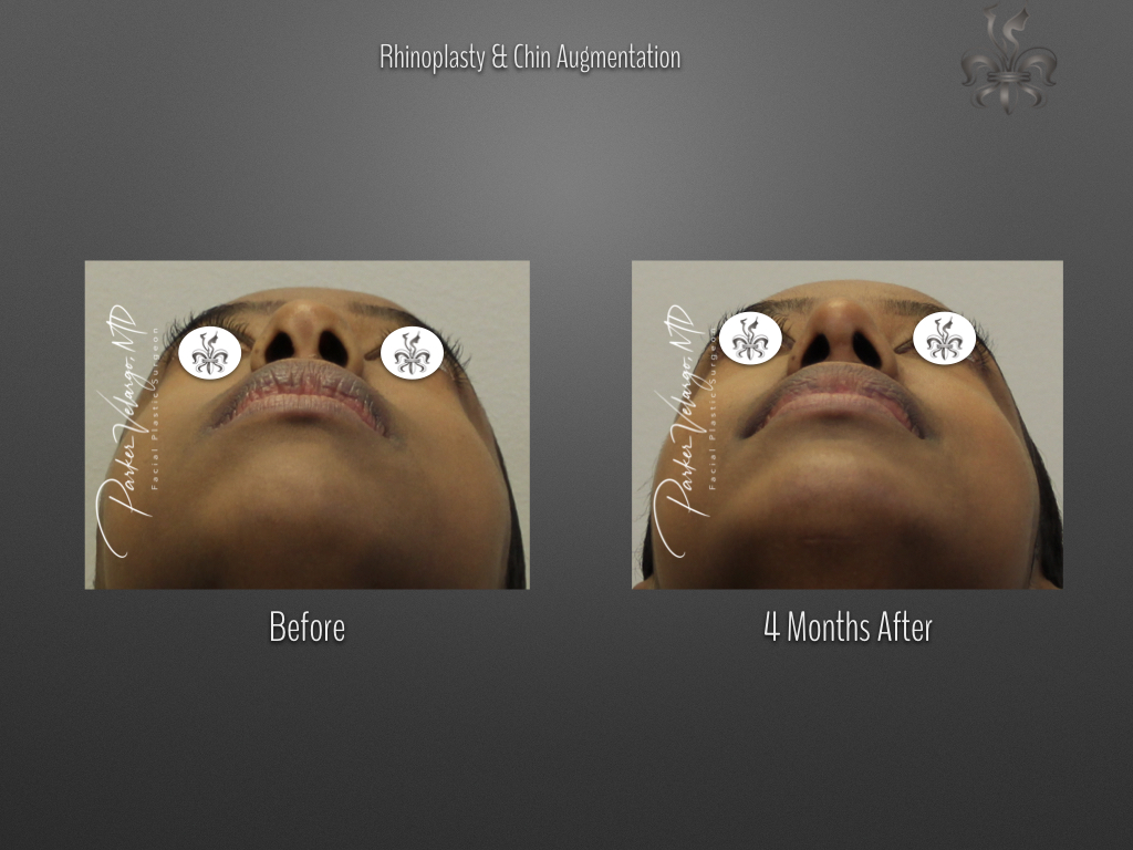 Rhinoplasty before and after