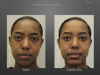 Rhinoplasty before and after