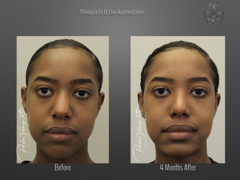 Rhinoplasty before and after