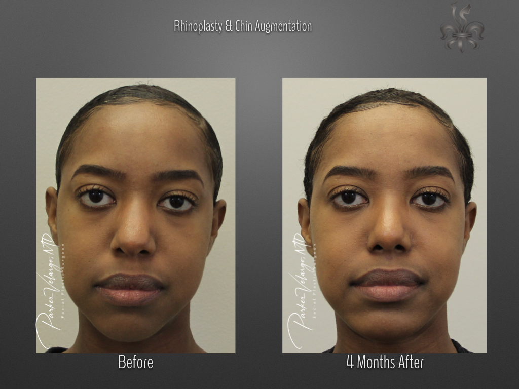 Rhinoplasty before and after