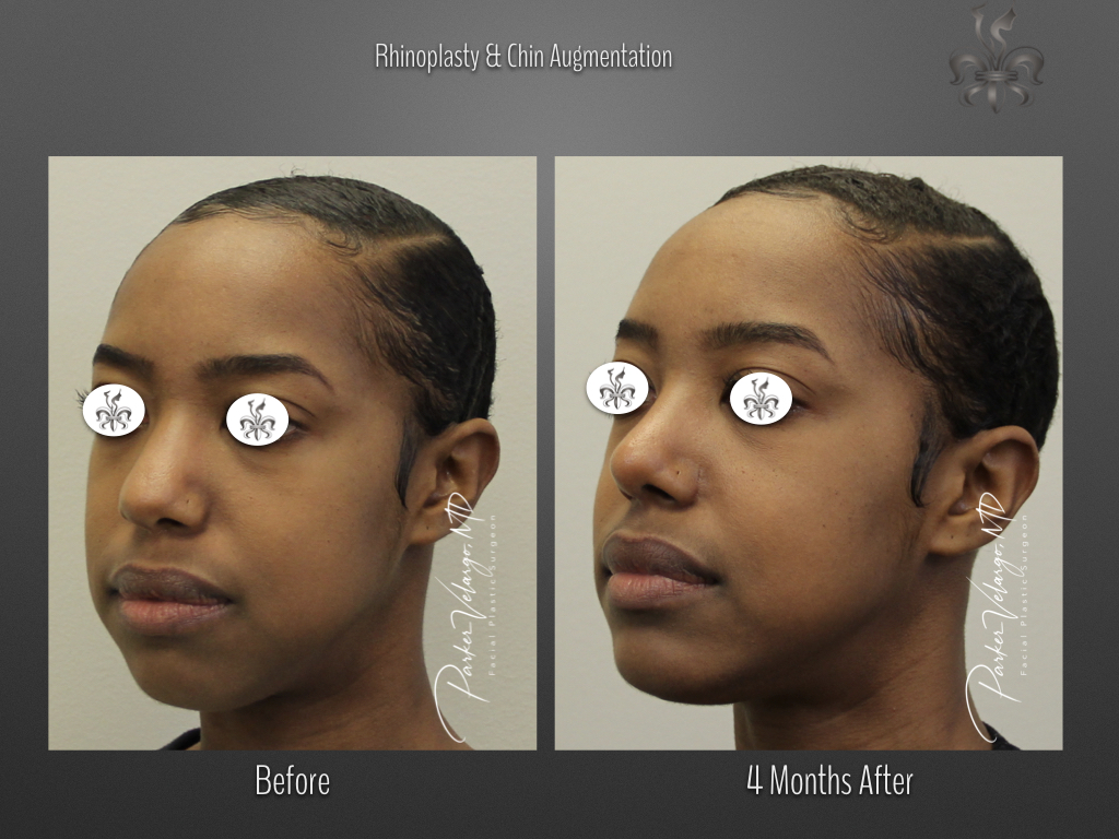 Rhinoplasty before and after