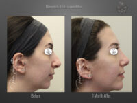 Rhinoplasty before and after