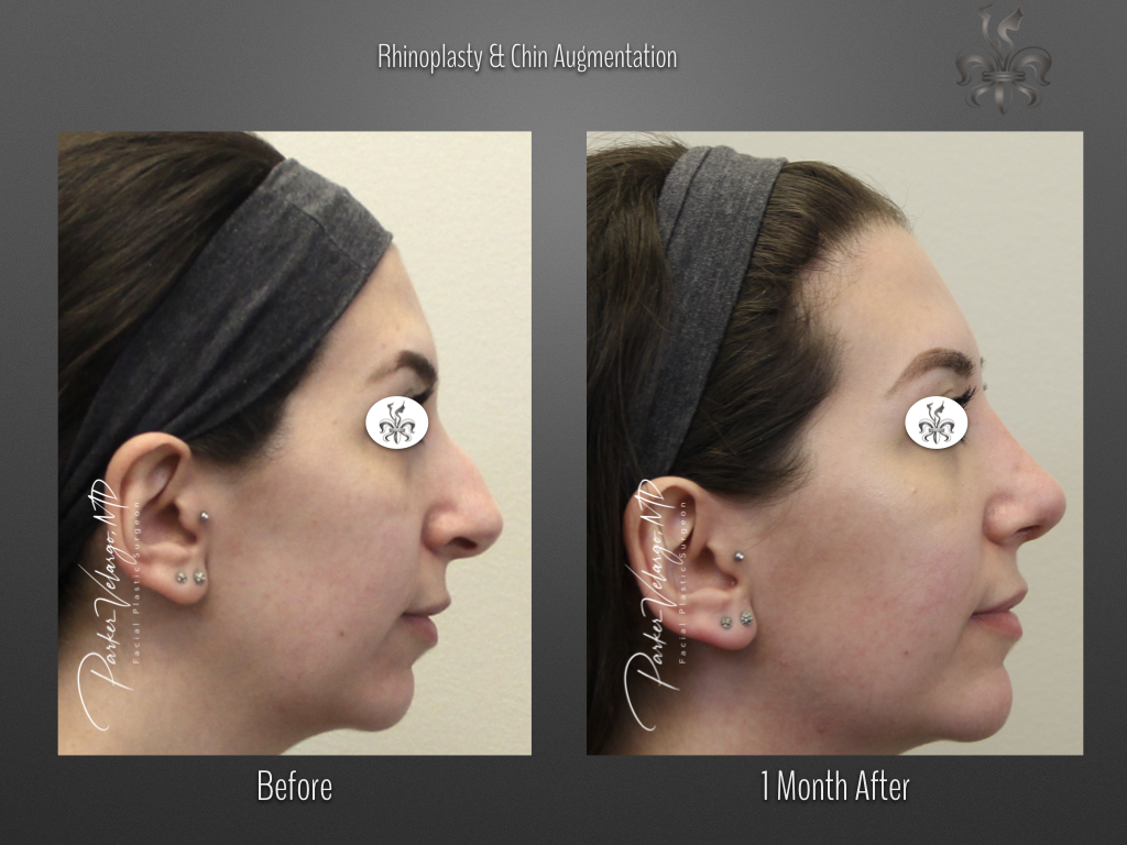 Rhinoplasty before and after