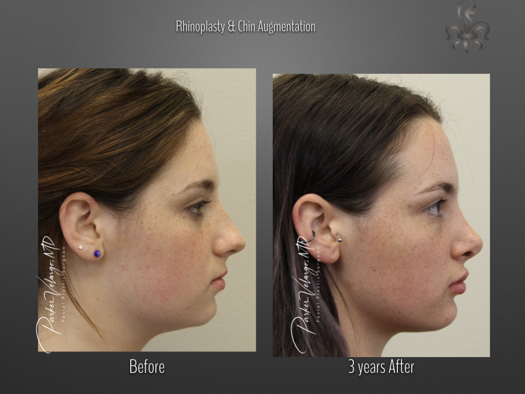 Rhinoplasty before and after