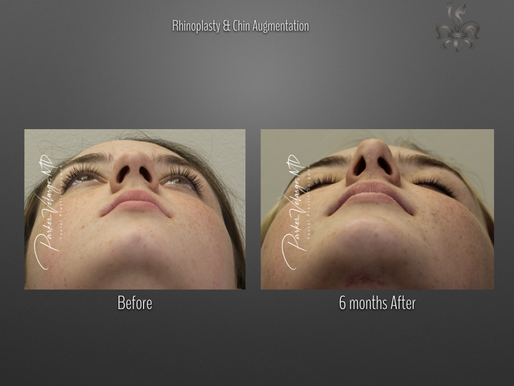 Rhinoplasty before and after
