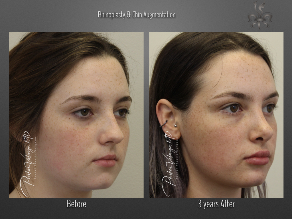 Rhinoplasty before and after