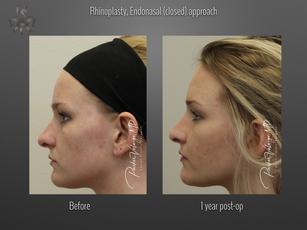 Rhinoplasty before and after