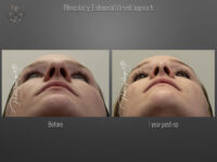 Rhinoplasty before and after