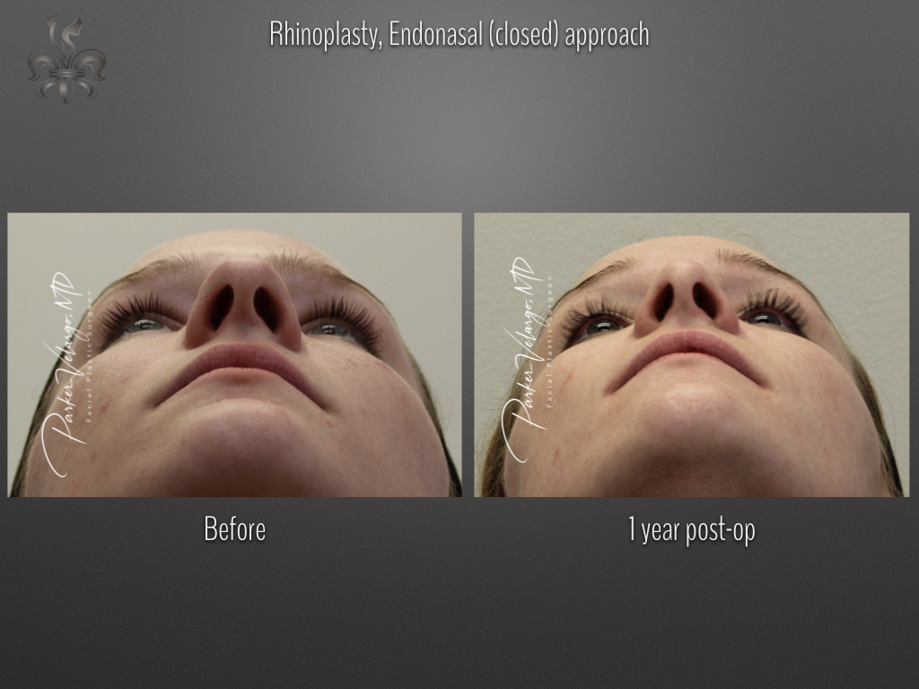 Rhinoplasty before and after
