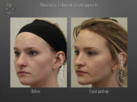 Rhinoplasty before and after