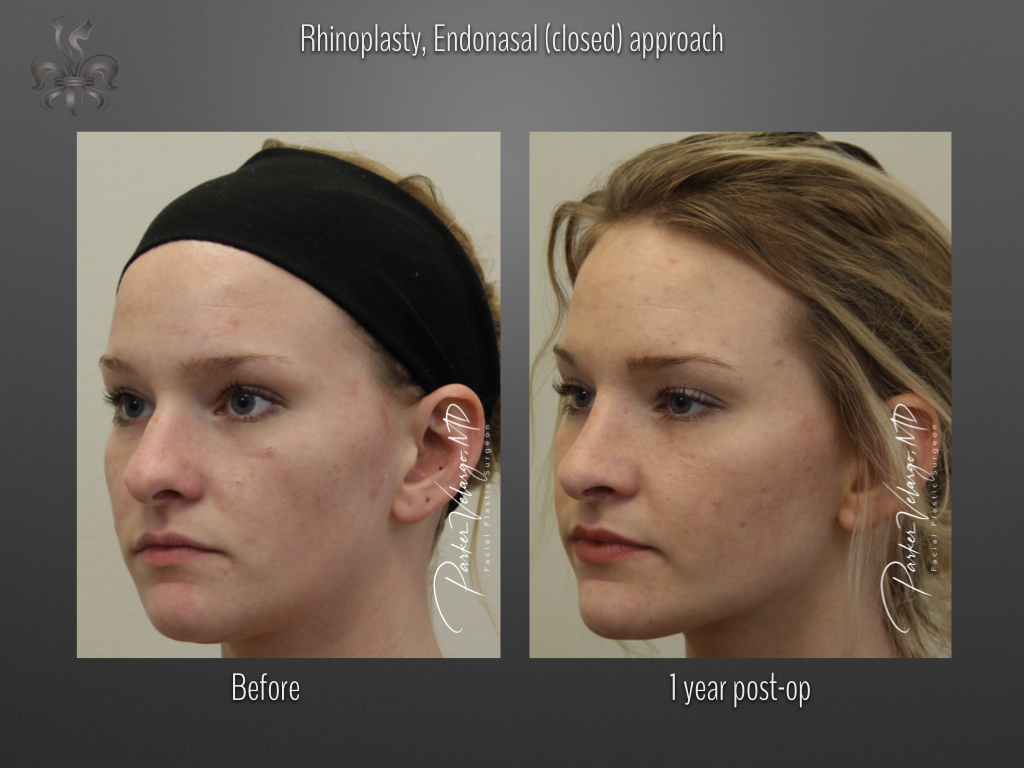 Rhinoplasty before and after