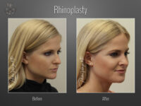 Rhinoplasty before and after