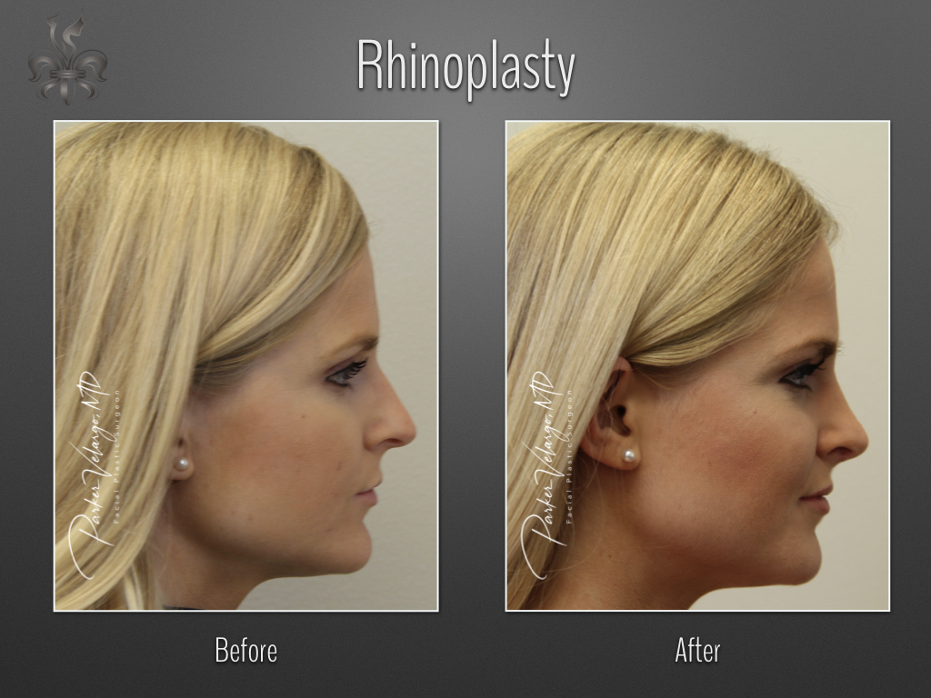 Rhinoplasty before and after
