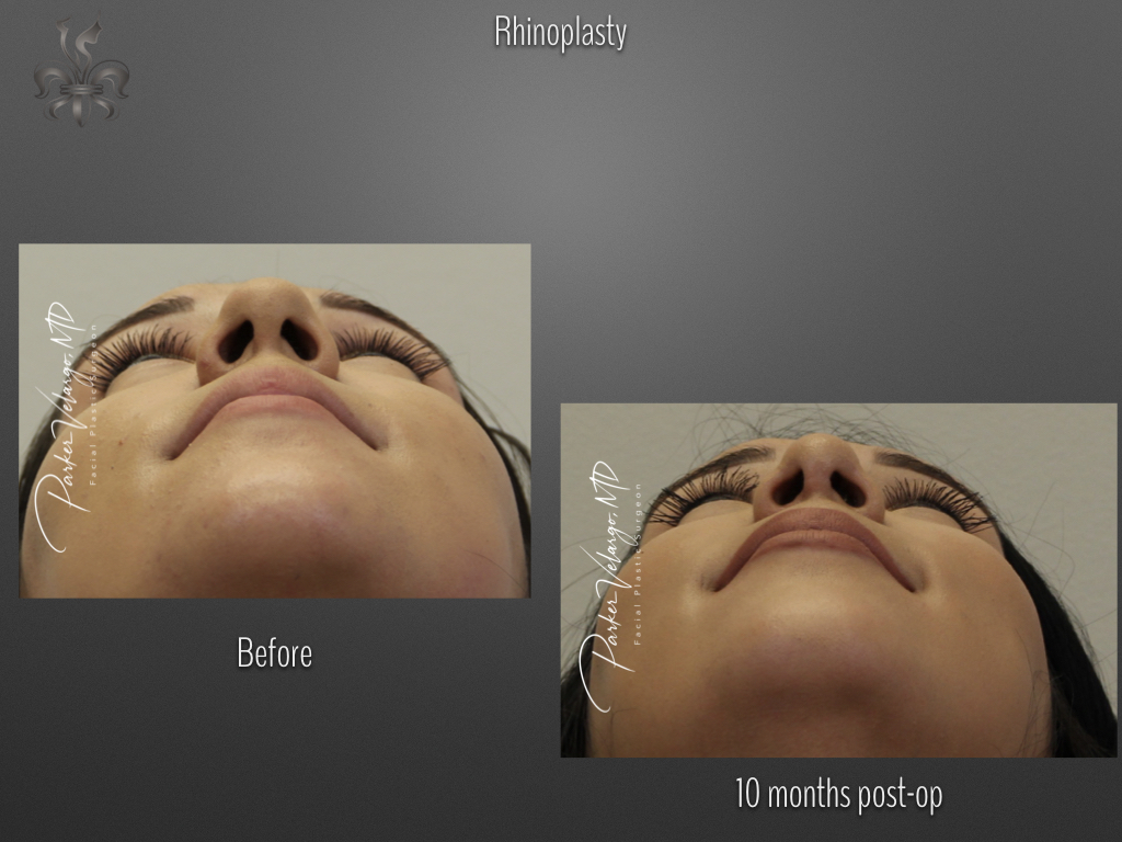 Rhinoplasty before and after