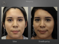 Rhinoplasty before and after