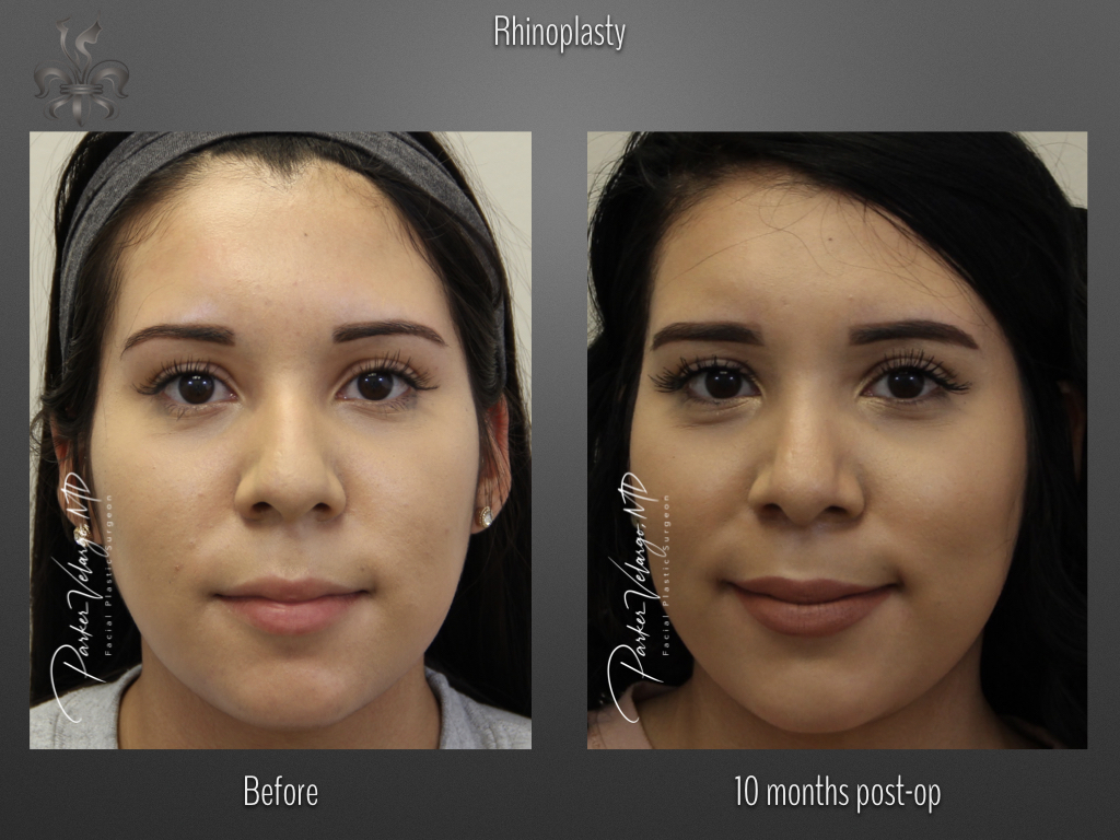 Rhinoplasty before and after