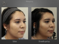Rhinoplasty before and after