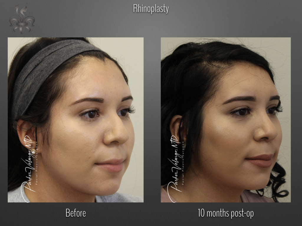 Rhinoplasty before and after
