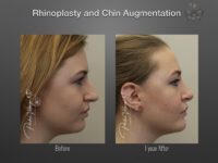 Rhinoplasty before and after