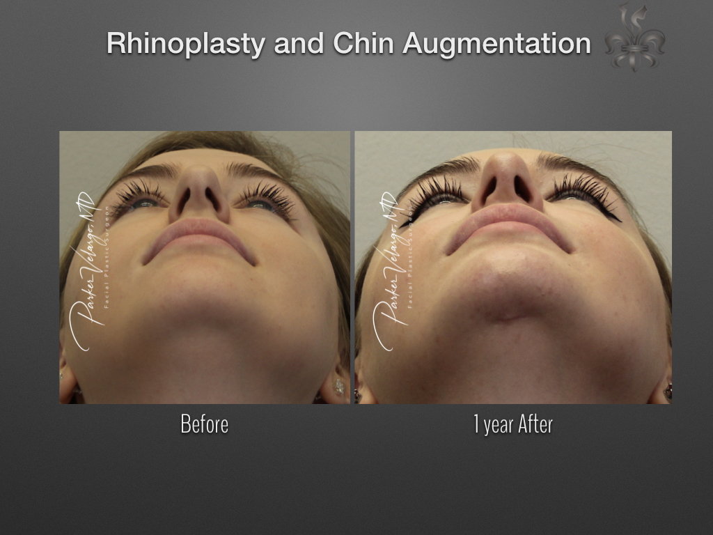 Rhinoplasty before and after