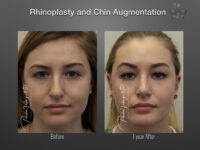 Rhinoplasty before and after