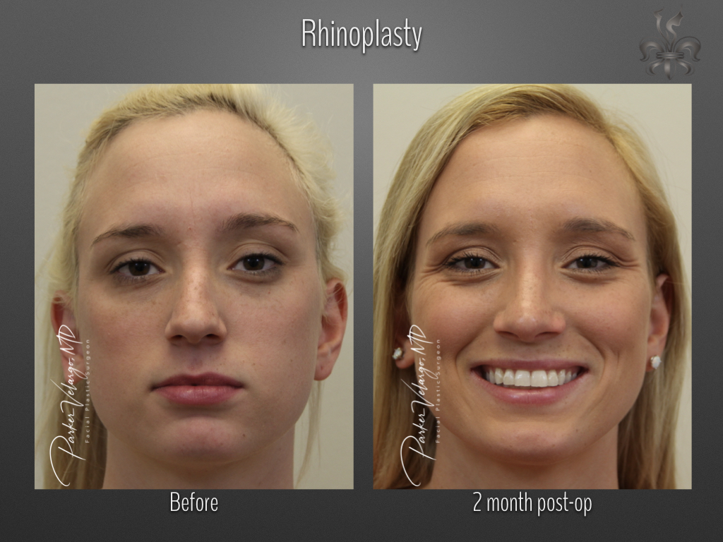 Rhinoplasty before and after