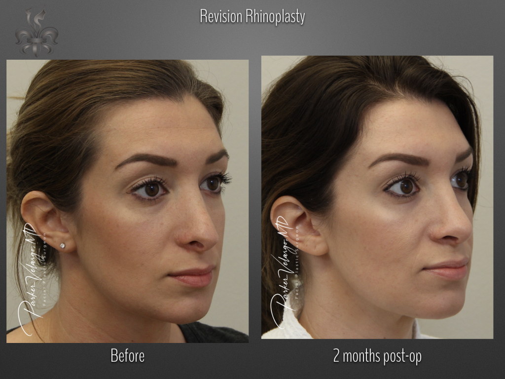 Rhinoplasty before and after