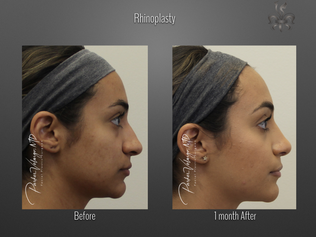 Rhinoplasty before and after