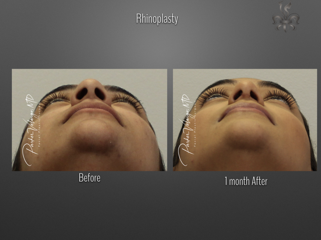 Rhinoplasty before and after