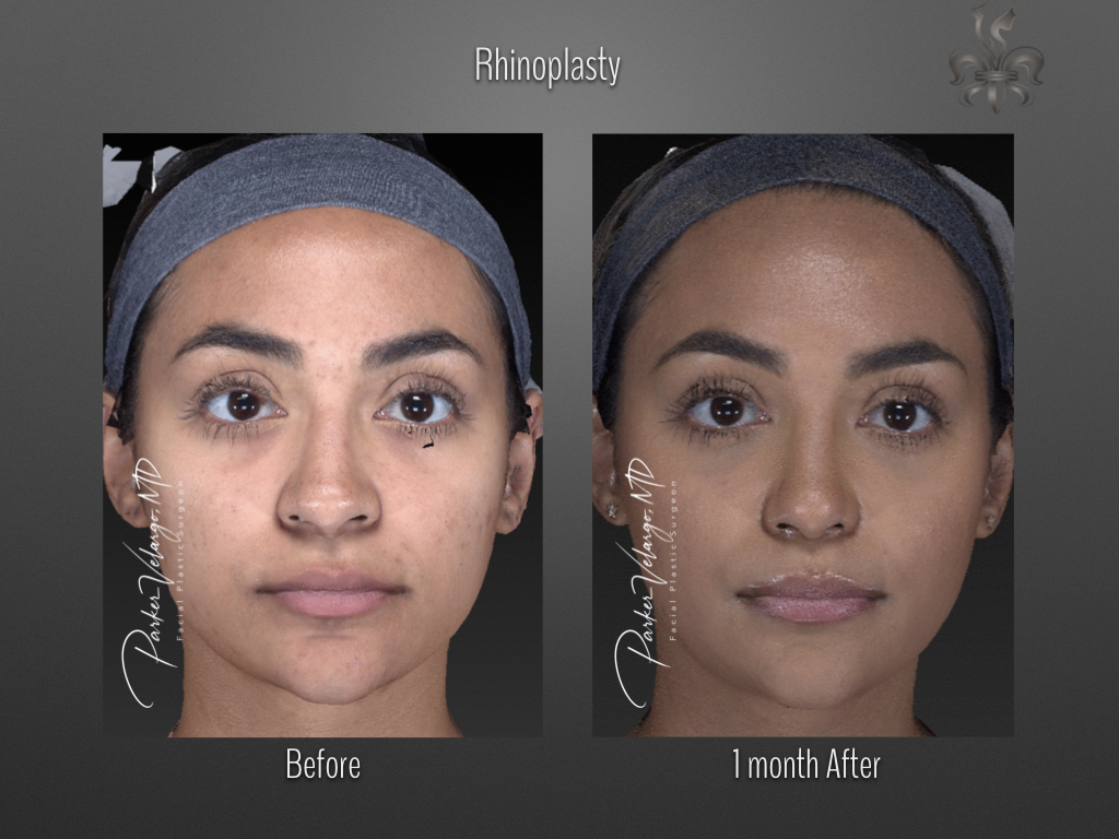 Rhinoplasty before and after