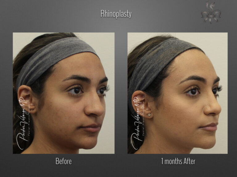 Rhinoplasty before and after