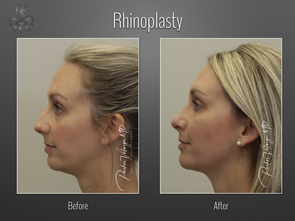 Rhinoplasty before and after