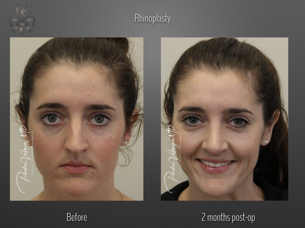 Rhinoplasty before and after