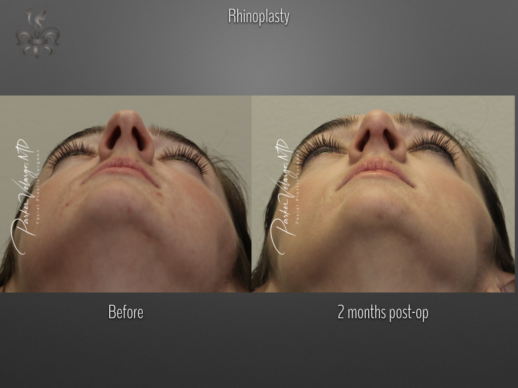 Rhinoplasty before and after