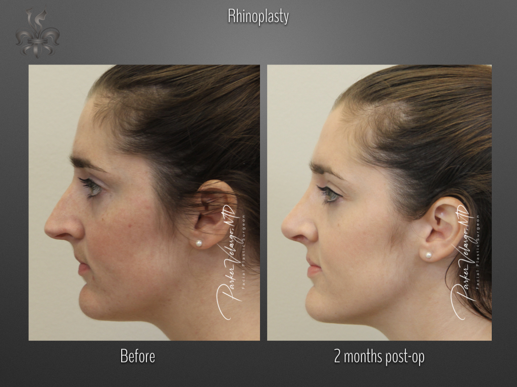 Rhinoplasty before and after