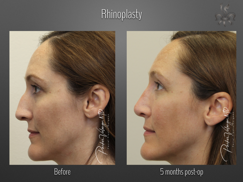 Rhinoplasty before and after