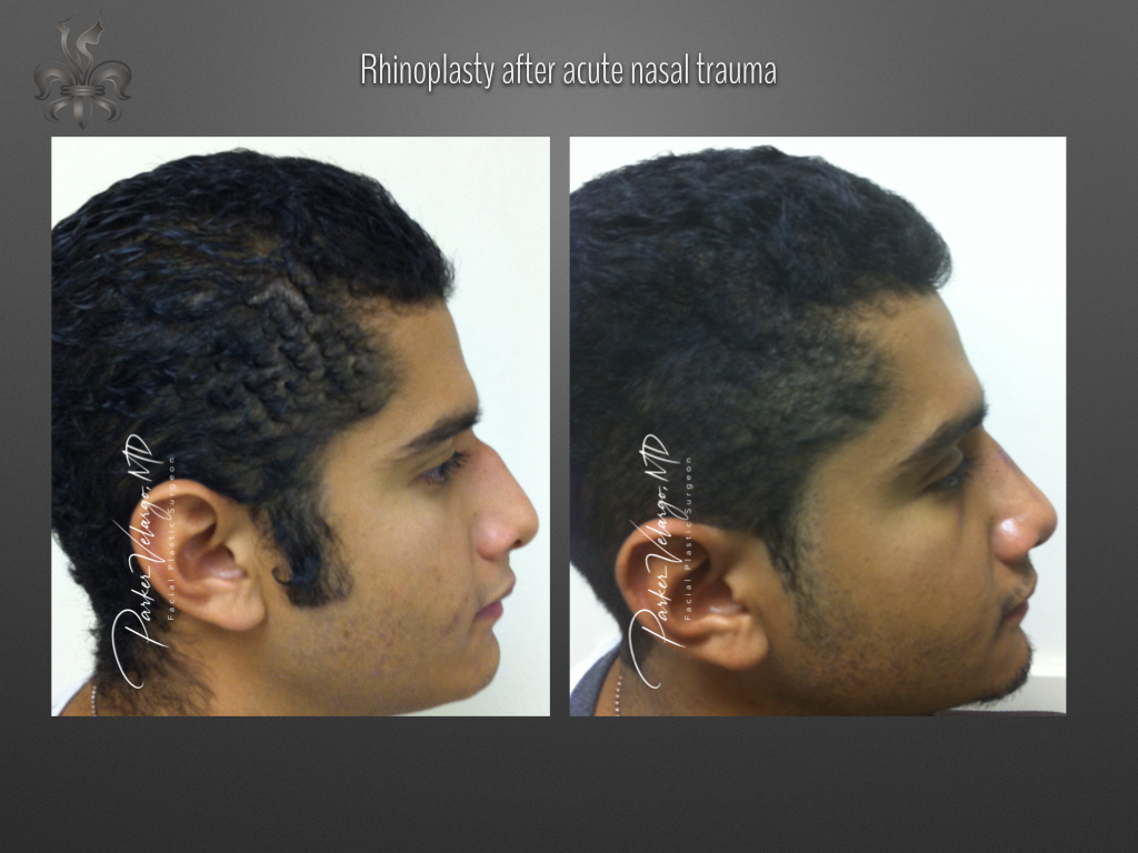 Rhinoplasty before and after