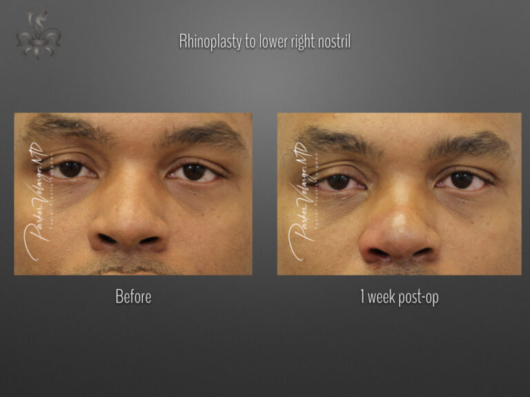 Rhinoplasty before and after