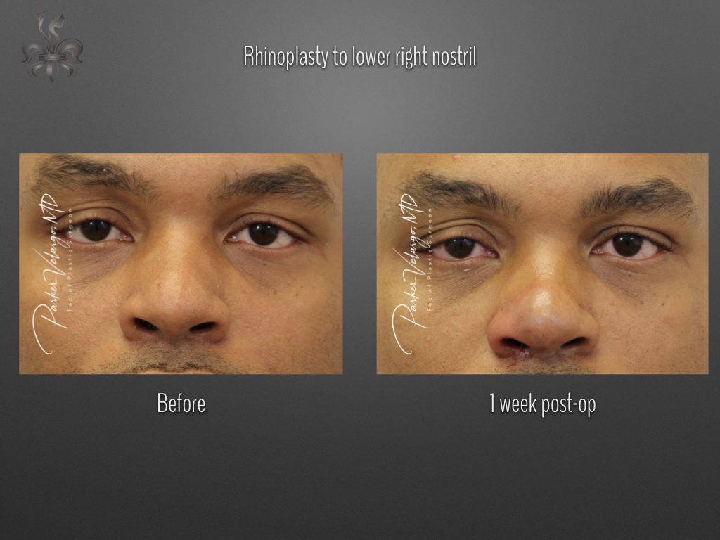 Rhinoplasty before and after