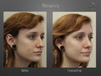 Rhinoplasty before and after