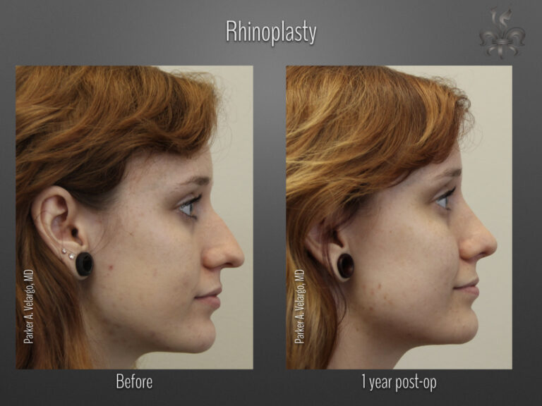 Rhinoplasty before and after