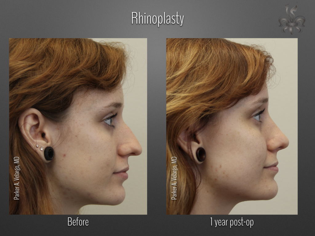Rhinoplasty before and after