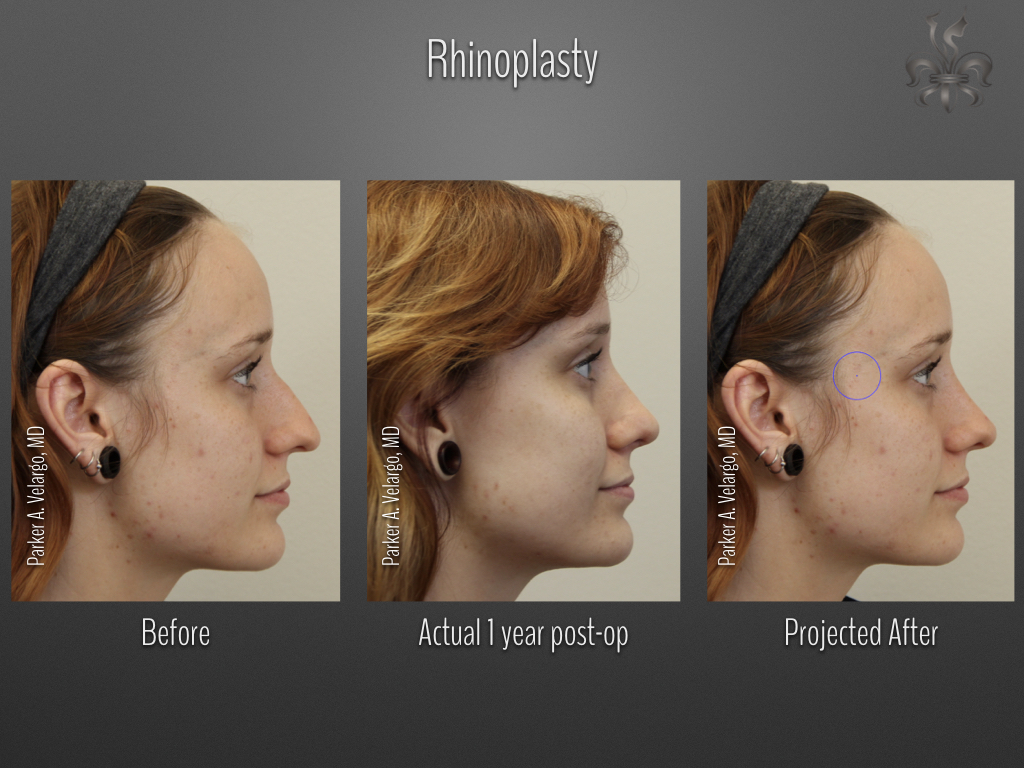 Rhinoplasty before and after