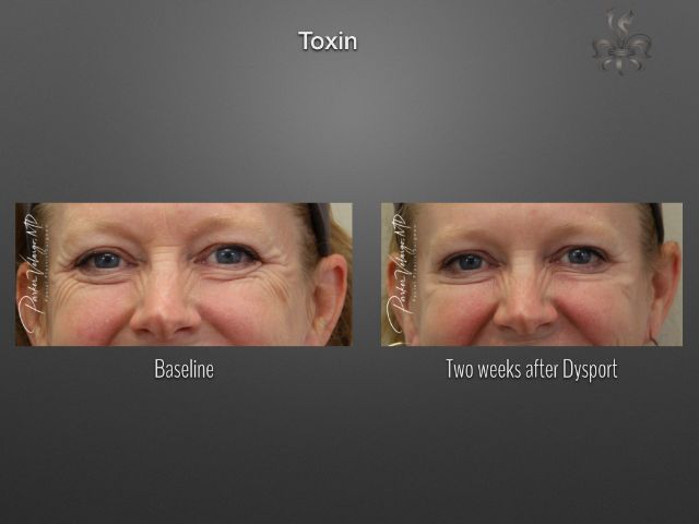 Botox/Dysport/Xeomin before and after