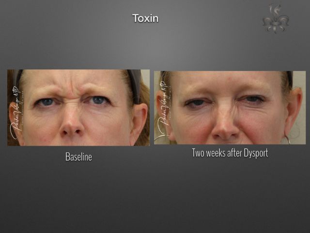 Botox/Dysport/Xeomin before and after