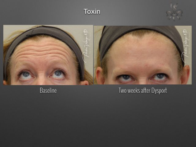 Botox/Dysport/Xeomin before and after