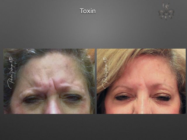 Botox/Dysport/Xeomin before and after