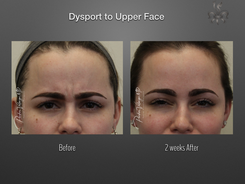 Botox/Dysport/Xeomin Before and After