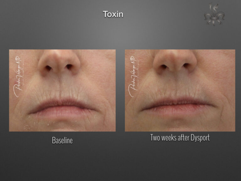 Botox/Dysport/Xeomin Before and After