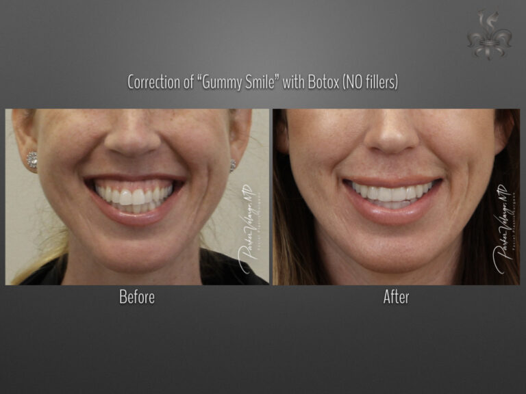 Botox/Dysport/Xeomin Before and After